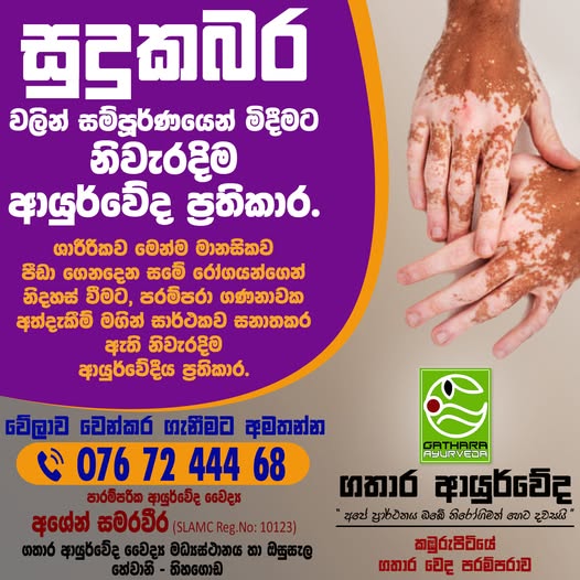 VITILIGO – සුදුකබර
